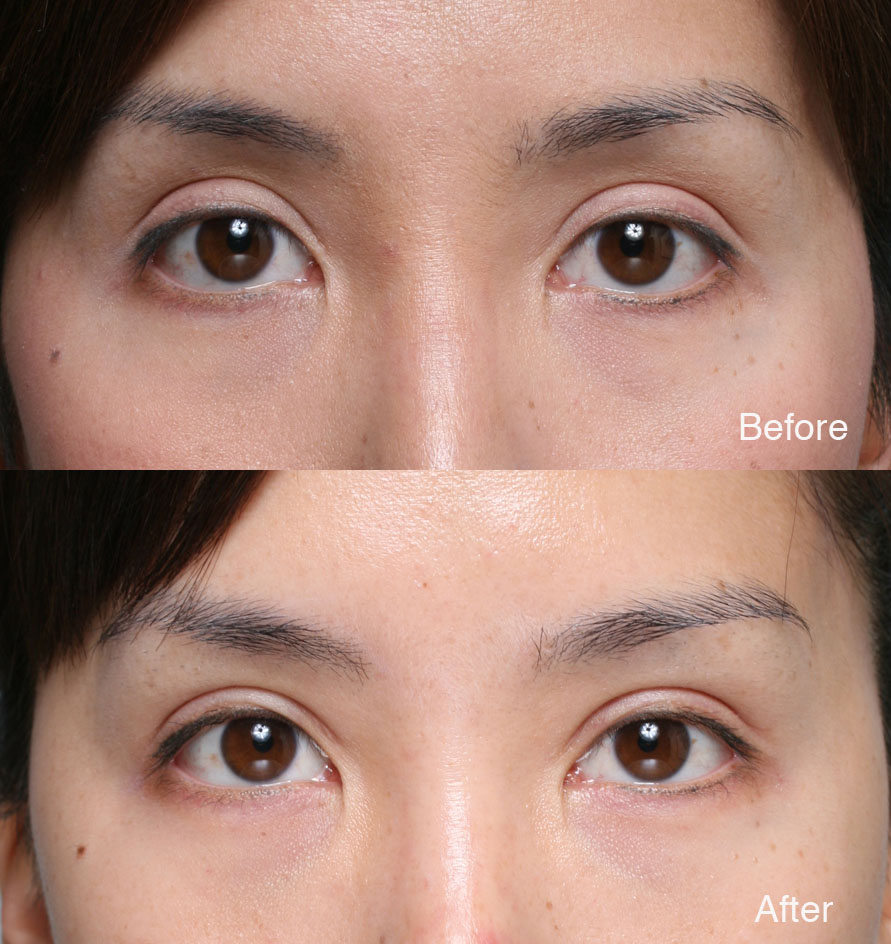 Asian Eyelid Surgery Pictures 82