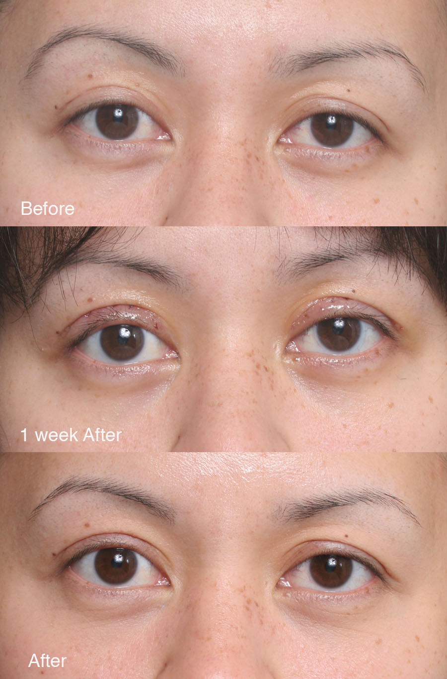 Asian Eyelid Surgery Pictures 105