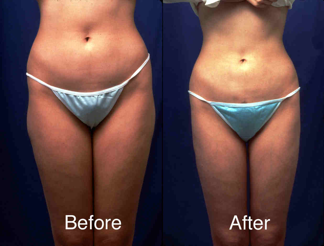 www liposuction