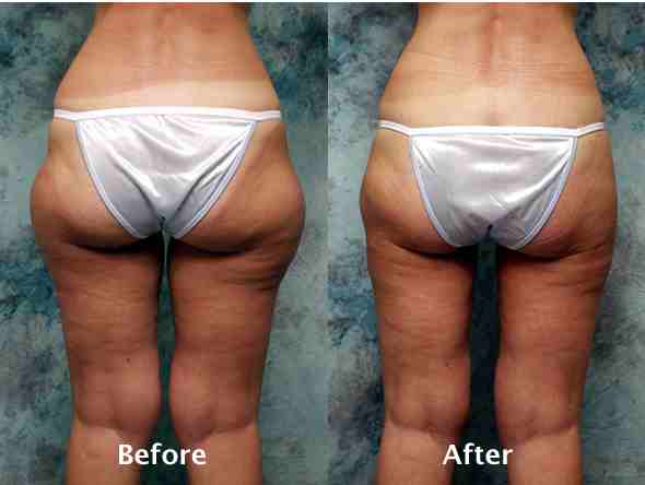 Liposuction Before & After Photos