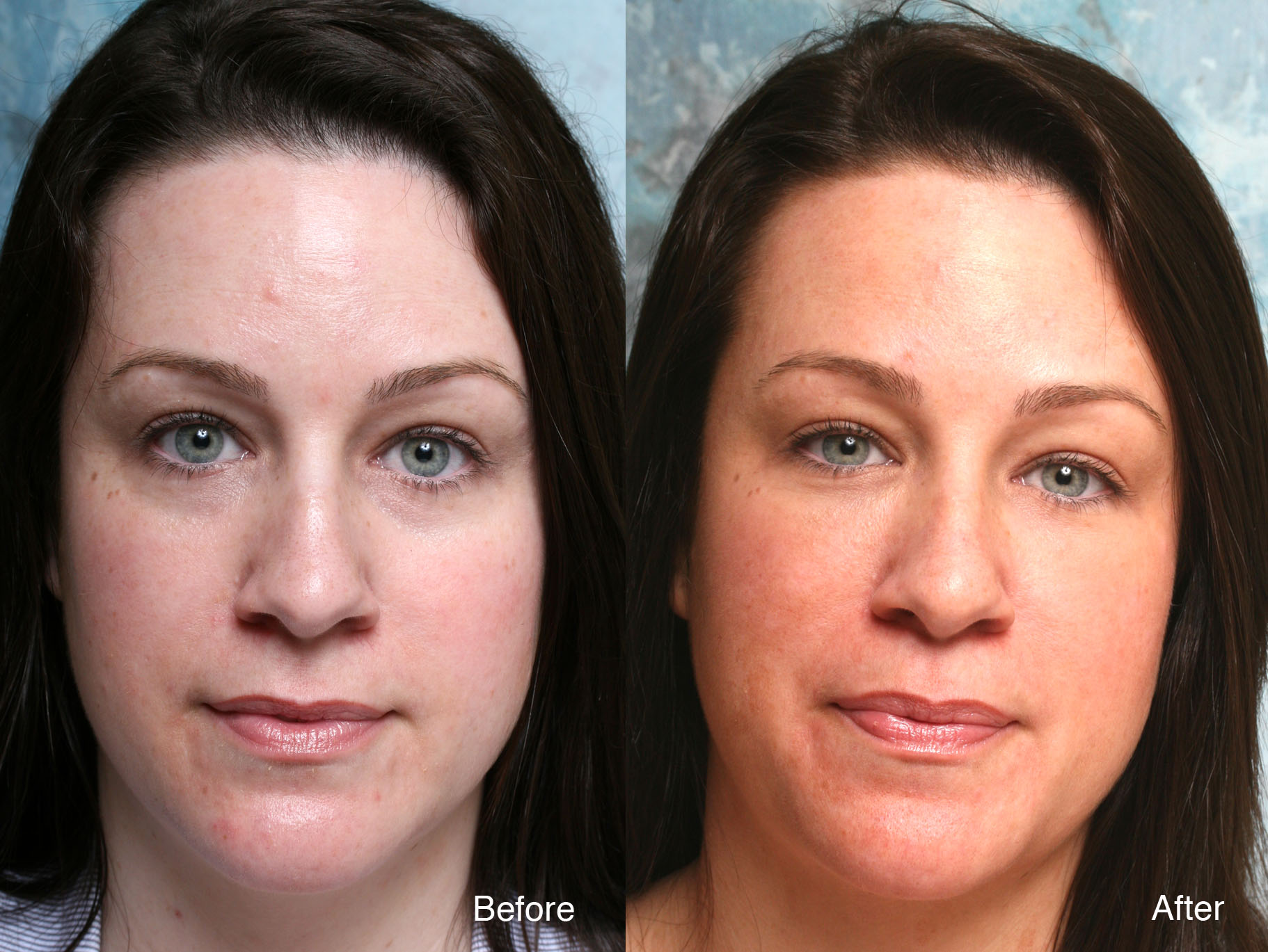 botox-case-studies-beverly-hills-dysport-beverly-hills-lidlift