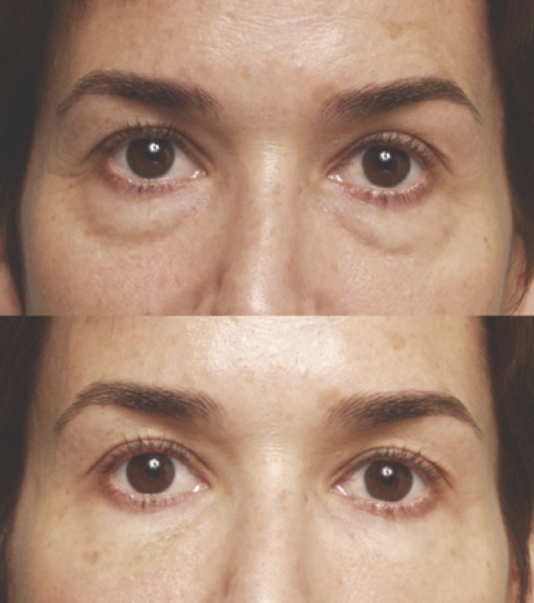 Eye Filler: Real Patient Photos and What to Expect