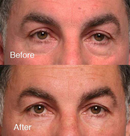 Eyebags Removal Surgery  Blepharoplasty in Orange County CA