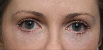 Lower Eyelids Surgery