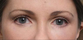 Lower Eyelids Surgery