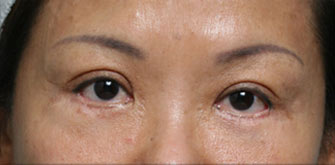 Lower Eyelids Surgery