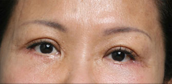 Lower Eyelids Surgery