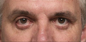 Lower Eyelids Surgery