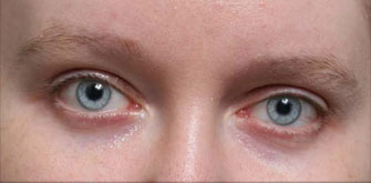 Ptosis-before-after