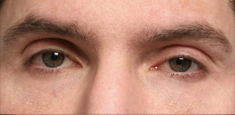 Ptosis-before-after