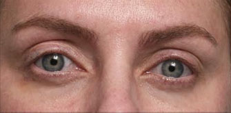 Ptosis-before-after
