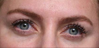Ptosis-before-after
