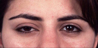 Ptosis-before-after