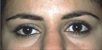Ptosis-before-after