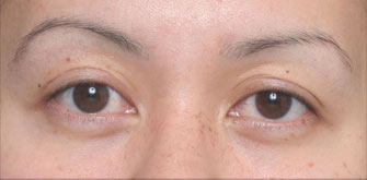 Ptosis-before-after