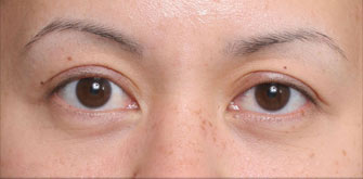 Ptosis-before-after