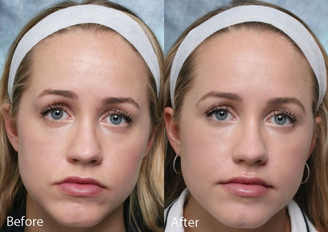 Fixing-Filler-Case-1