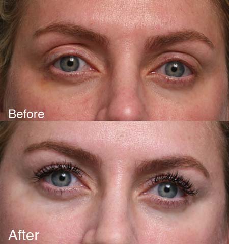 Fixing-upper-eyelids-2